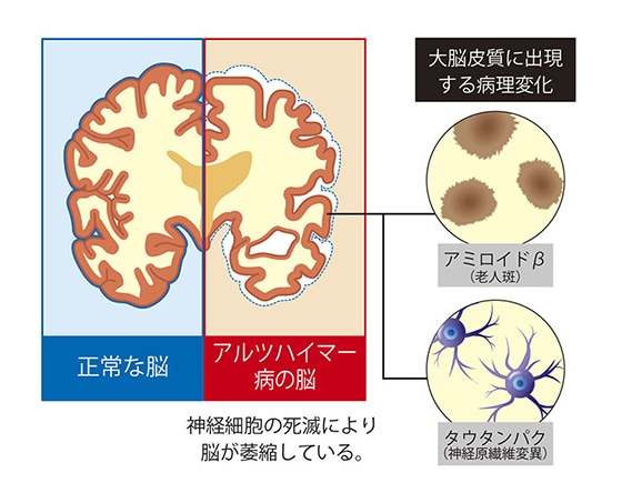 血液検査による早期検出を目指したアルツハイマー病のイメージ図