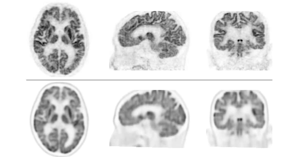 上段：本PET装置により得られた脳FDG-PET画像　　下段：従来型装置により得られた脳FDG-PET画像 上段の画像の方が分解能が高く、細かいところまでみえる。下段の方は少しぼやけてみえる。