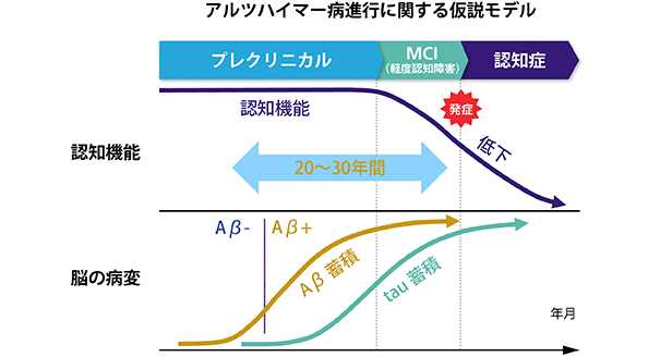 アルツハイマー病進行に関する仮説モデル