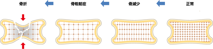 正常→骨減少→骨粗鬆症→骨折