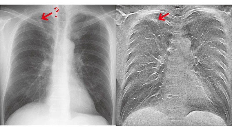 左側が胸部単純X線画像、右側が胸部トモシンセシス画像