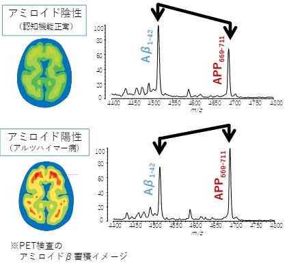 アルツハイマー病PET画像と早期検出を目指した血液検査測定結果のイメージ図