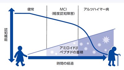 アルツハイマー病の進行に関する仮説モデル