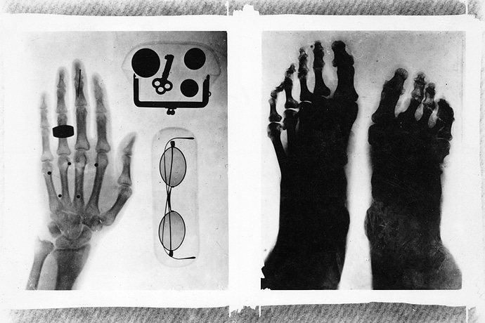 〔初期のX線写真〕真明治29年のX線写真で村岡博士の眼
					鏡、財布、糟谷助手の手および戦傷した橋本中佐の足を撮影したもの
